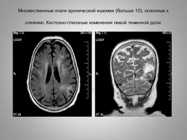 Множественные очаги хронической ишемии (больше 10), склонные к слиянию. Кистозно-глиозные изменения левой теменной доли.