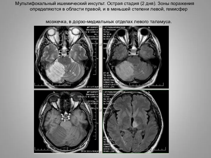 Мультифокальный ишемический инсульт. Острая стадия (2 дня). Зоны поражения определяются