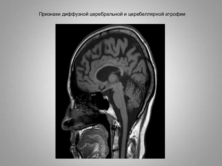 Признаки диффузной церебральной и церебеллярной атрофии