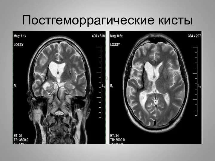 Постгеморрагические кисты