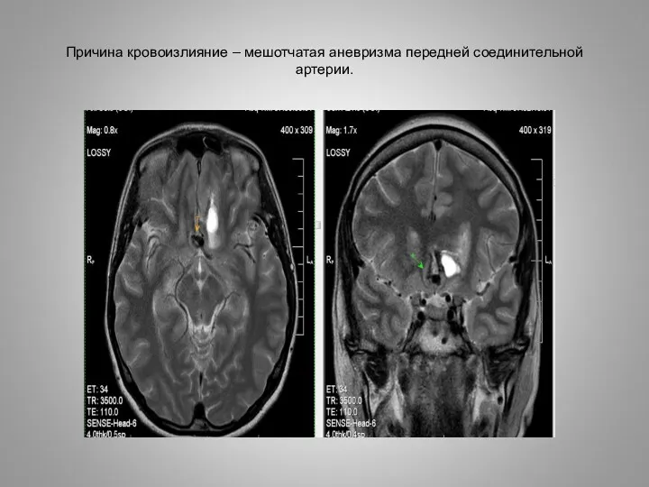 Причина кровоизлияние – мешотчатая аневризма передней соединительной артерии.