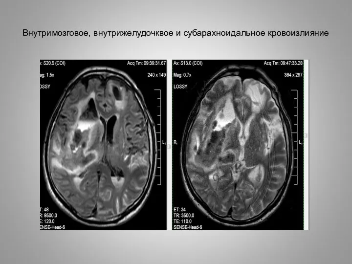 Внутримозговое, внутрижелудочквое и субарахноидальное кровоизлияние