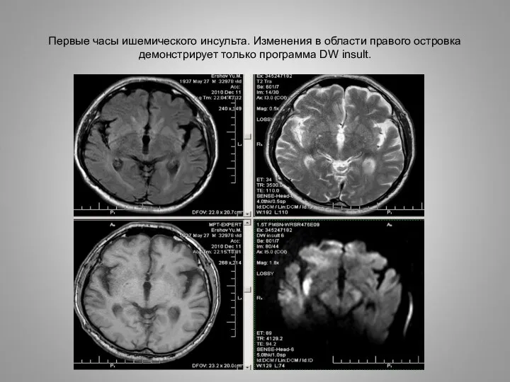 Первые часы ишемического инсульта. Изменения в области правого островка демонстрирует только программа DW insult.