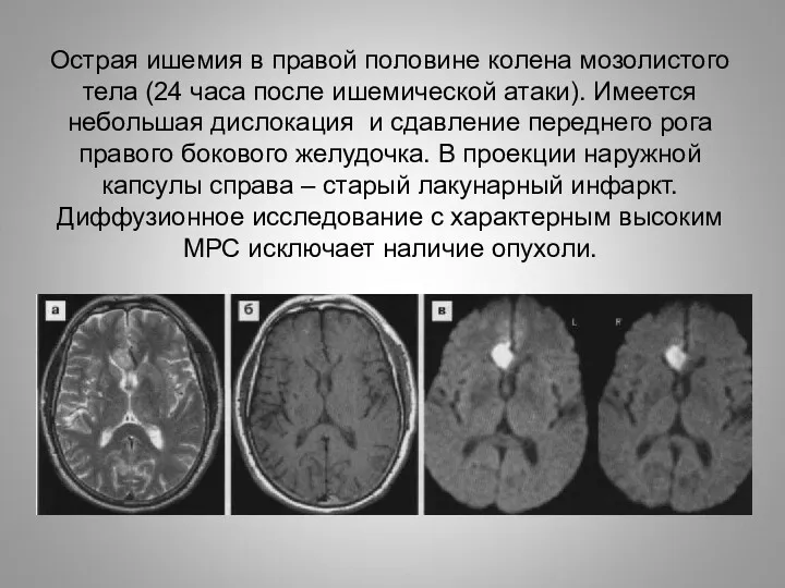 Острая ишемия в правой половине колена мозолистого тела (24 часа