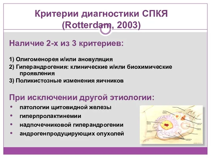 Критерии диагностики СПКЯ (Rotterdam, 2003) Наличие 2-х из 3 критериев: