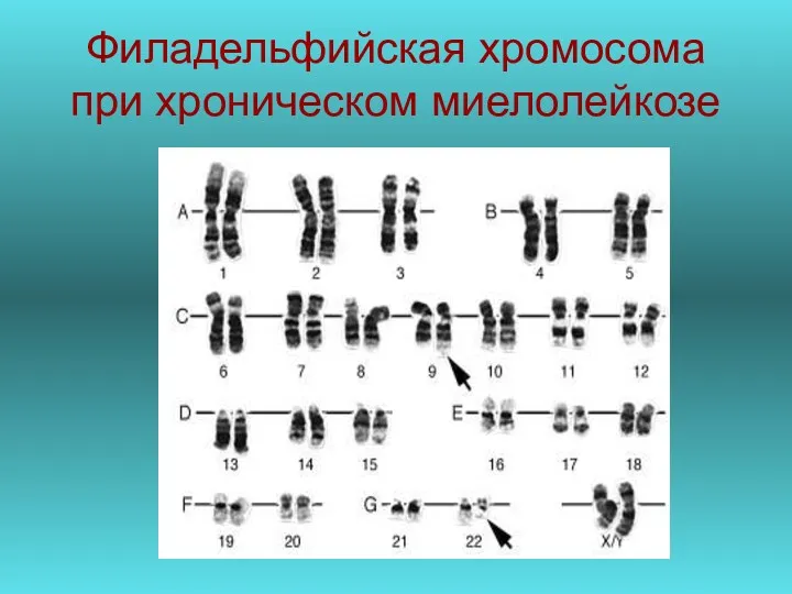 Филадельфийская хромосома при хроническом миелолейкозе