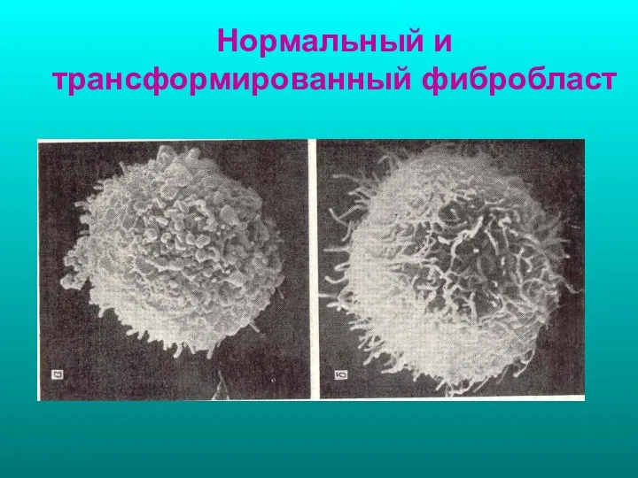 Нормальный и трансформированный фибробласт