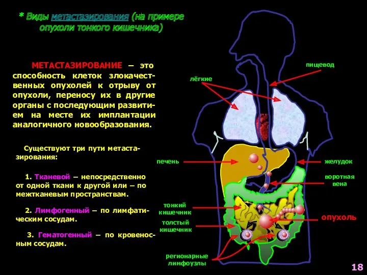 * Виды метастазирования (на примере опухоли тонкого кишечника) пищевод желудок