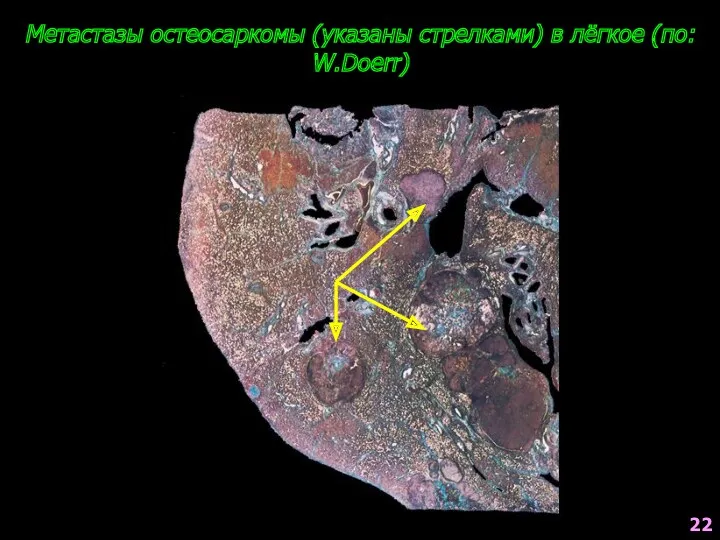 Метастазы остеосаркомы (указаны стрелками) в лёгкое (по: W.Doerr) 22