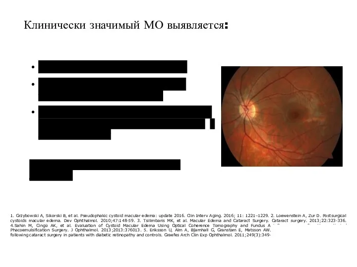 при офтальмоскопии в 0,1-2,35% 1,2 по данным оптической когерентной томографии