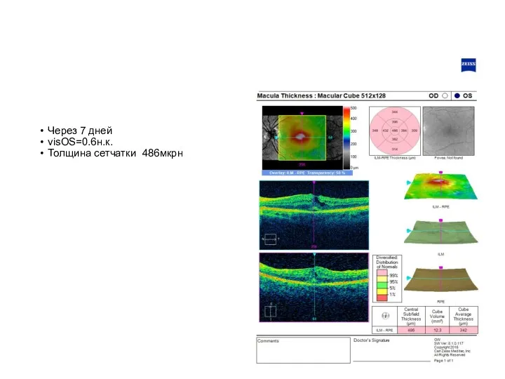 Через 7 дней visOS=0.6н.к. Толщина сетчатки 486мкрн