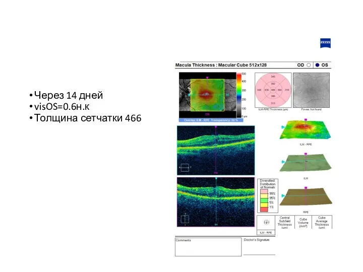 Через 14 дней visOS=0.6н.к Толщина сетчатки 466