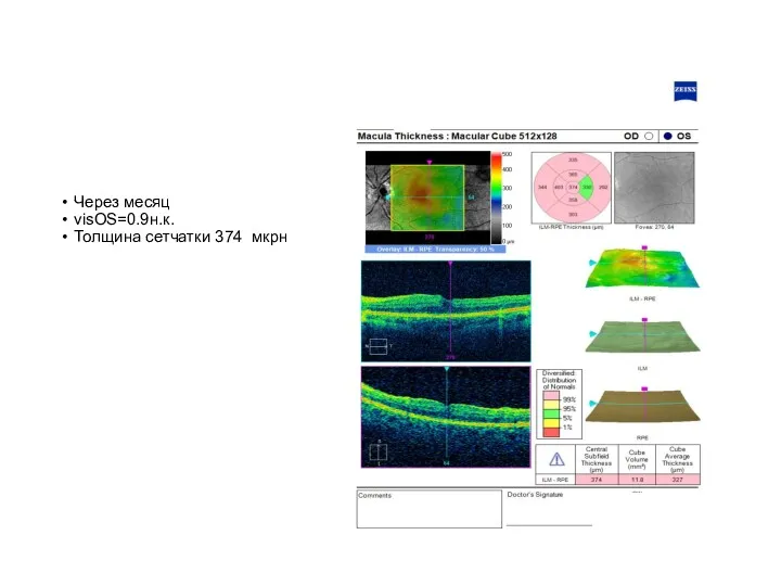 Через месяц visOS=0.9н.к. Толщина сетчатки 374 мкрн