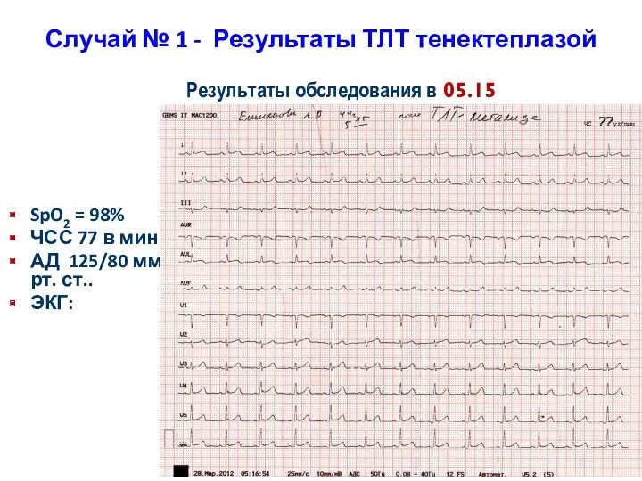 Случай № 1 - Результаты ТЛТ тенектеплазой SpO2 = 98% ЧСС 77 в