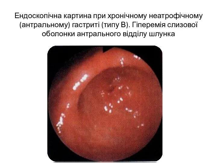 Ендоскопічна картина при хронічному неатрофічному (антральному) гастриті (типу В). Гіперемія слизової оболонки антрального відділу шлунка