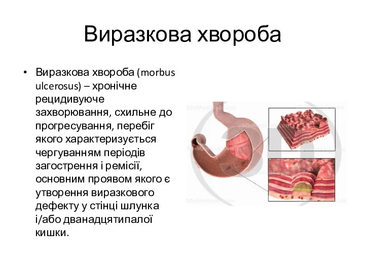 Виразкова хвороба Виразкова хвороба (morbus ulcerosus) – хронічне рецидивуюче захворювання,