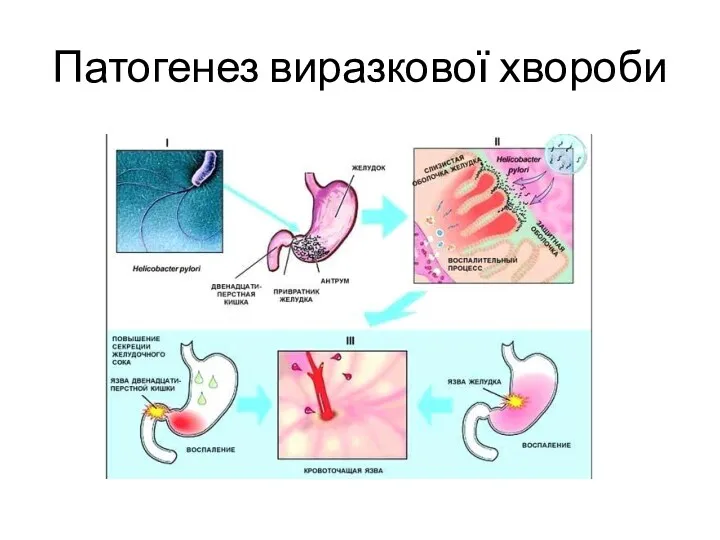 Патогенез виразкової хвороби