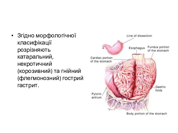 Згідно морфологічної класифікації розрізняють катаральний, некротичний (корозивний) та гнійний (флегмонозний) гострий гастрит.