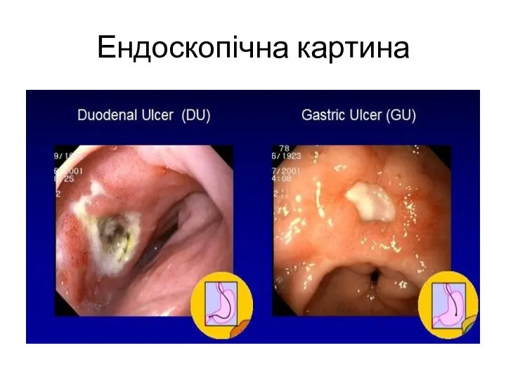 Ендоскопічна картина