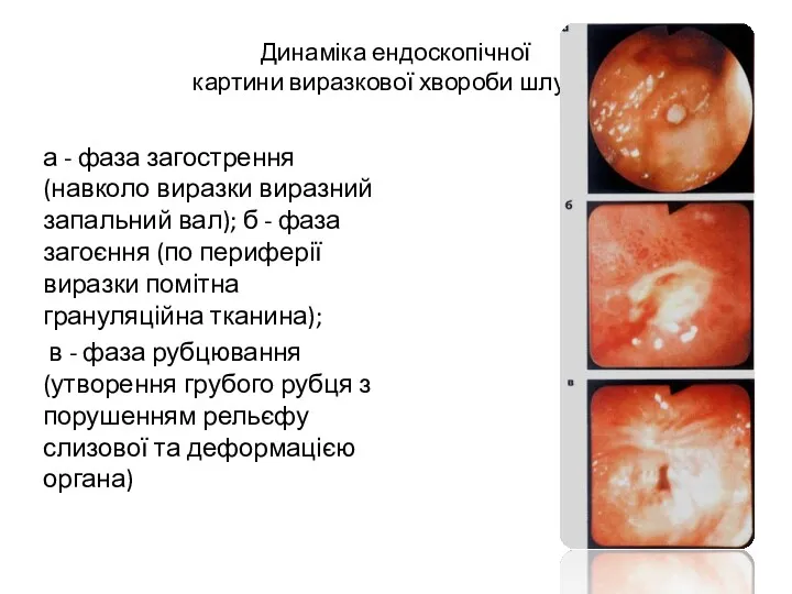 Динаміка ендоскопічної картини виразкової хвороби шлунка а - фаза загострення