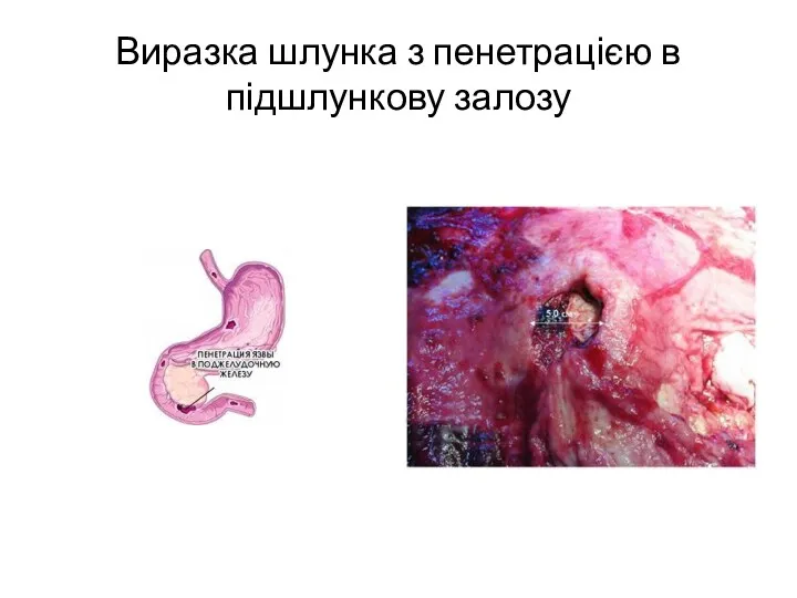 Виразка шлунка з пенетрацією в підшлункову залозу