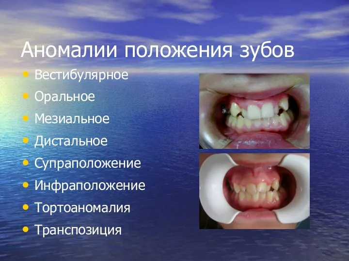 Аномалии положения зубов Вестибулярное Оральное Мезиальное Дистальное Супраположение Инфраположение Тортоаномалия Транспозиция