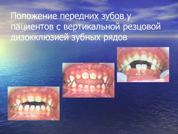 Положение передних зубов у пациентов с вертикальной резцовой дизокклюзией зубных рядов