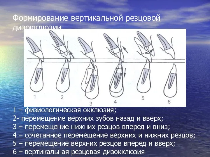 Формирование вертикальной резцовой дизокклюзии 1 – физиологическая окклюзия; 2- перемещение