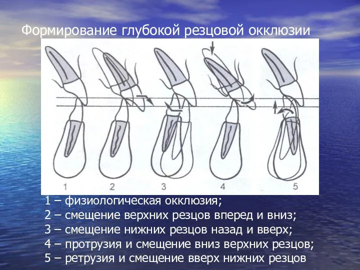 Формирование глубокой резцовой окклюзии 1 – физиологическая окклюзия; 2 –