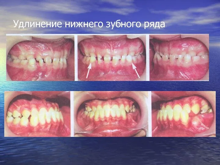 Удлинение нижнего зубного ряда