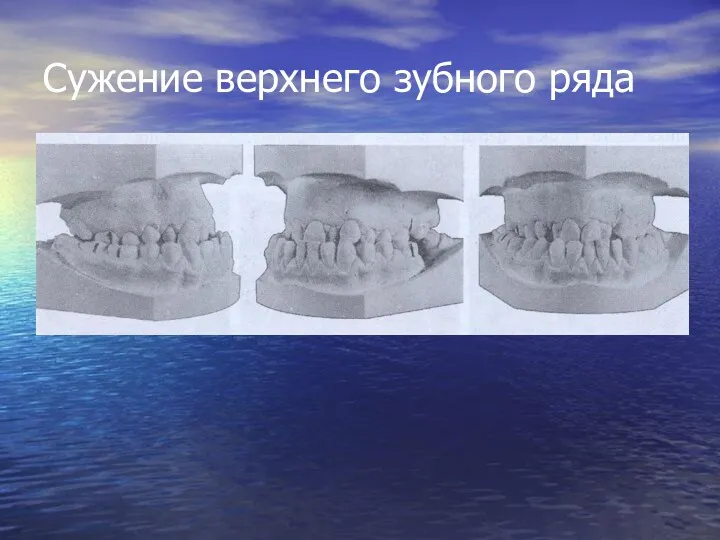 Сужение верхнего зубного ряда