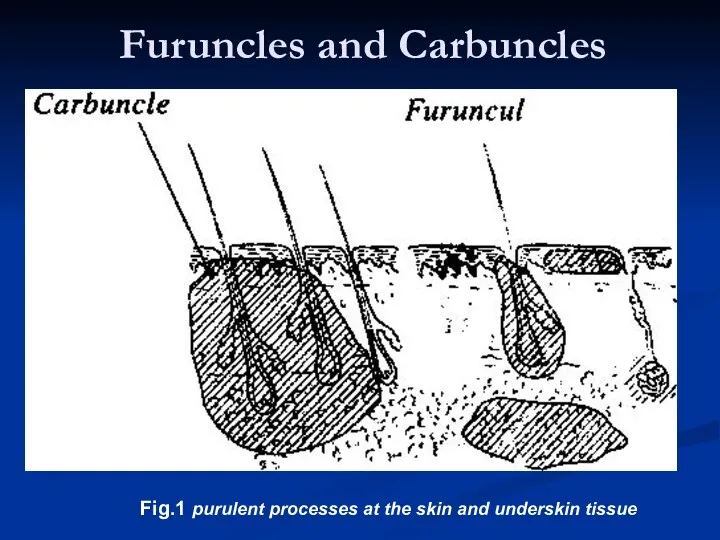 Furuncles and Carbuncles Fig.1 purulent processes at the skin and underskin tissue