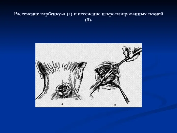 Рассечение карбункула (а) и иссечение некротизированных тканей (б).