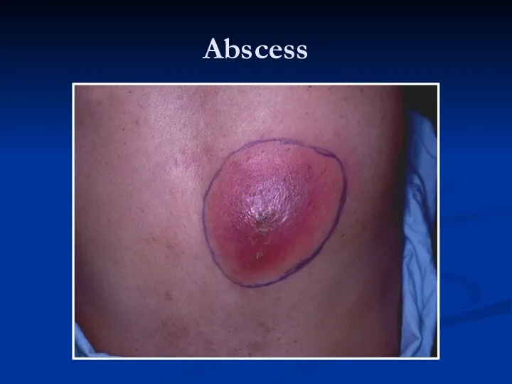 Abscess