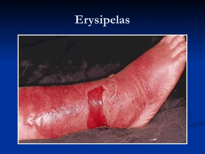 Erysipelas