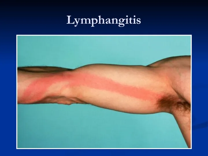 Lymphangitis