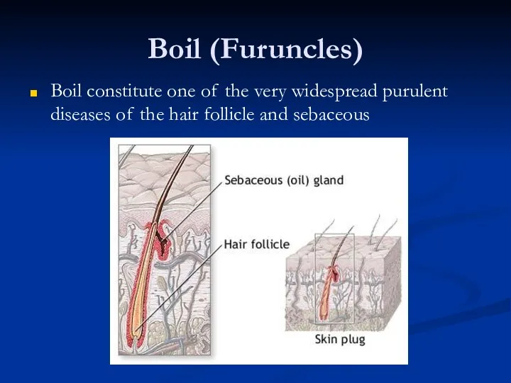 Boil (Furuncles) Boil constitute one of the very widespread purulent diseases of the