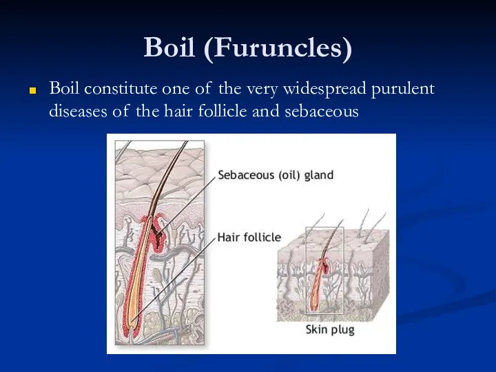 Boil (Furuncles) Boil constitute one of the very widespread purulent