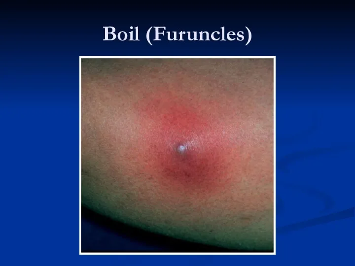Boil (Furuncles)