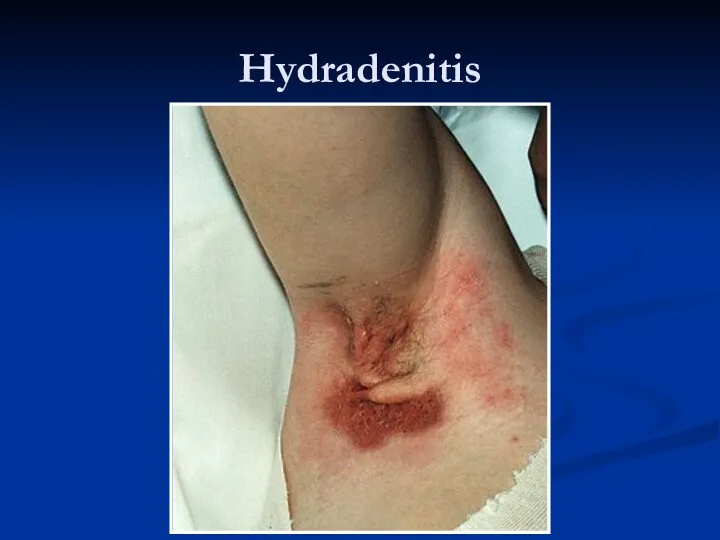 Hydradenitis
