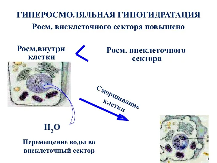 ГИПЕРОСМОЛЯЛЬНАЯ ГИПОГИДРАТАЦИЯ Росм. внеклеточного сектора повышено Росм.внутри клетки Н2О Росм.