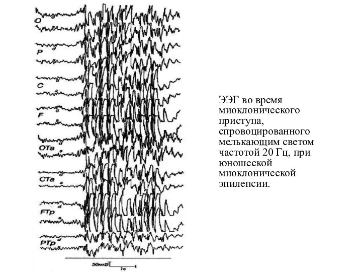 ЭЭГ во время миоклонического приступа, спровоцированного мелькающим светом частотой 20 Гц, при юношеской миоклонической эпилепсии.