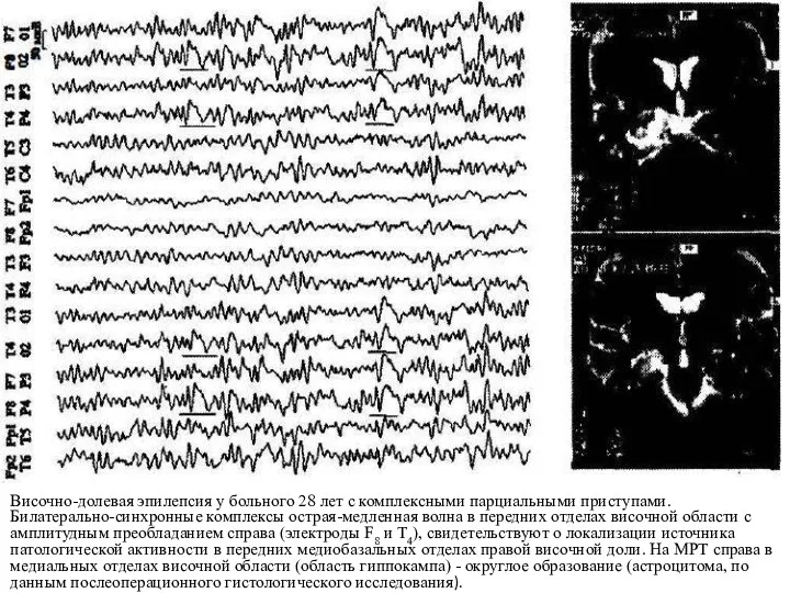 Височно-долевая эпилепсия у больного 28 лет с комплексными парциальными приступами.