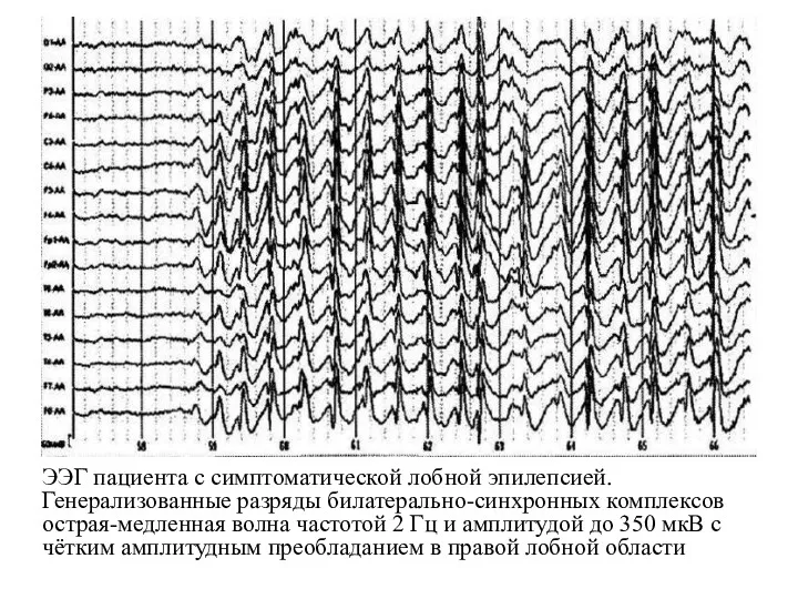 ЭЭГ пациента с симптоматической лобной эпилепсией. Генерализованные разряды билатерально-синхронных комплексов