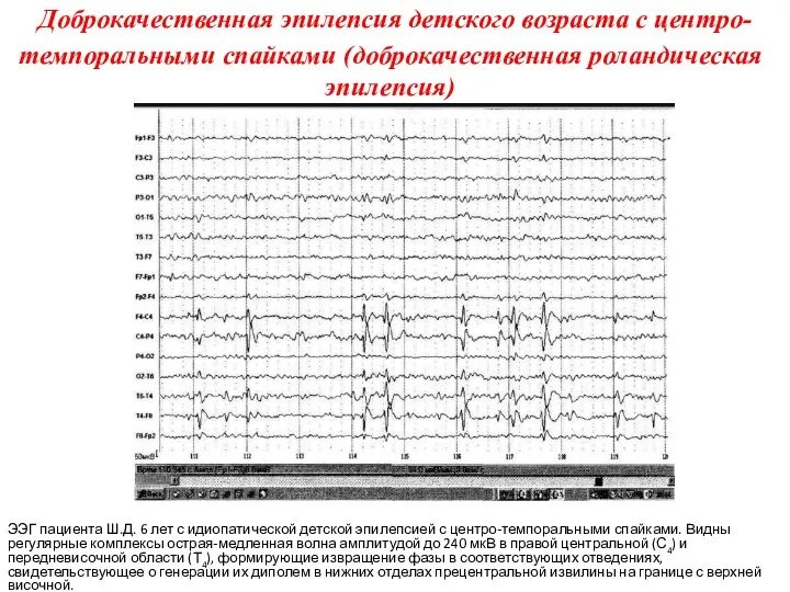 Доброкачественная эпилепсия детского возраста с центро-темпоральными спайками (доброкачественная роландическая эпилепсия)