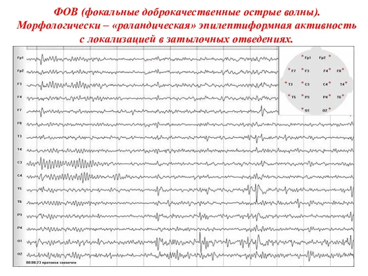 ФОВ (фокальные доброкачественные острые волны). Морфологически – «роландическая» эпилептиформная активность с локализацией в затылочных отведениях.
