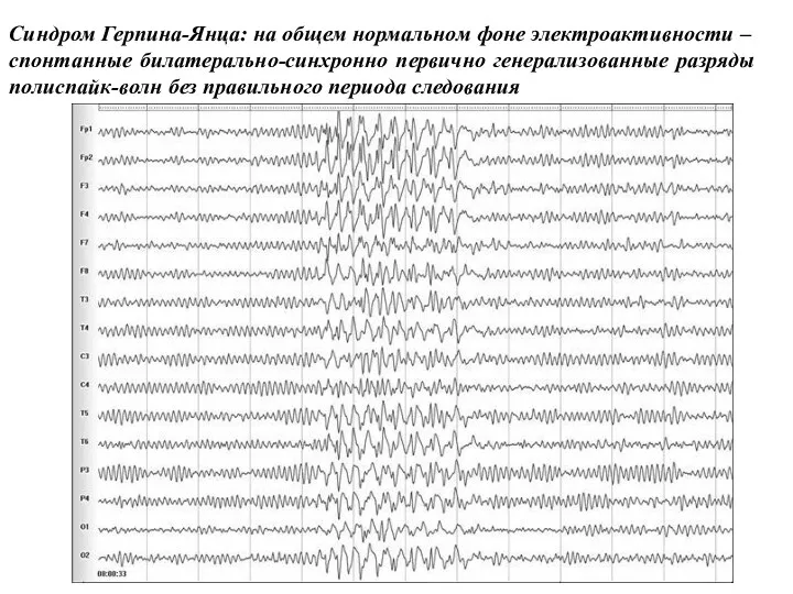 Синдром Герпина-Янца: на общем нормальном фоне электроактивности – спонтанные билатерально-синхронно