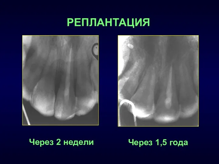 Через 1,5 года РЕПЛАНТАЦИЯ Через 2 недели