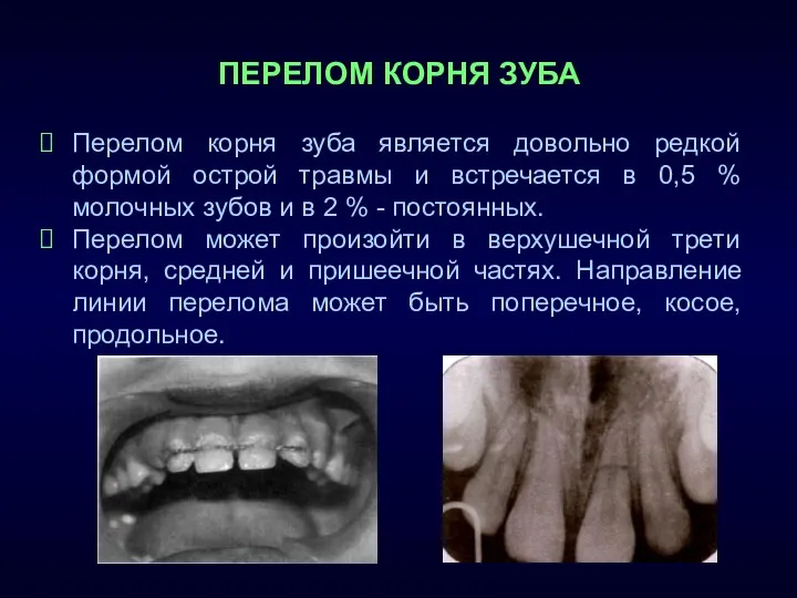 ПЕРЕЛОМ КОРНЯ ЗУБА Перелом корня зуба является довольно редкой формой