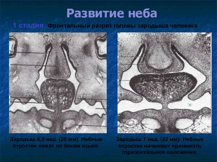 Развитие неба 1 стадия. Фронтальный разрез головы зародыша человека Зародыш